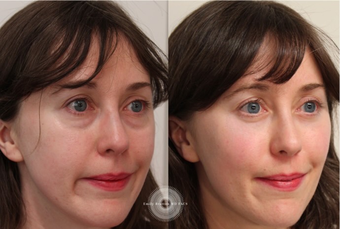 Instagram post by Dr. Emily M. Bratton: ✨Refreshed and Natural✨ My beautiful patient after lower blepharoplasty and fat grafting looking bright! #fatgrafting #blepharoplasty #eyeba…