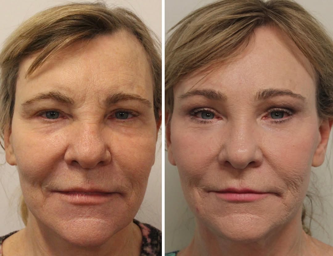 Instagram post by Dr. Emily M. Bratton: This lovely patient wanted a softer look and refresh without being over done. She had a previous lower face and neck lift many years ago alo…