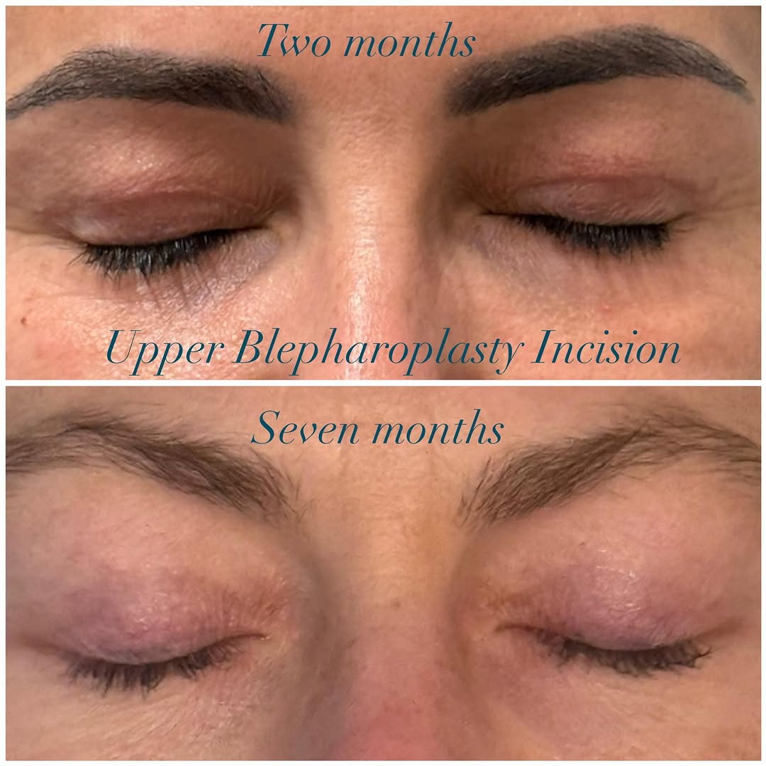 Instagram post by Dr. Emily M. Bratton: The difference time makes as an upper blepharoplasty incision fades away! Here are two different patients at 2 months and 7 months after upp…