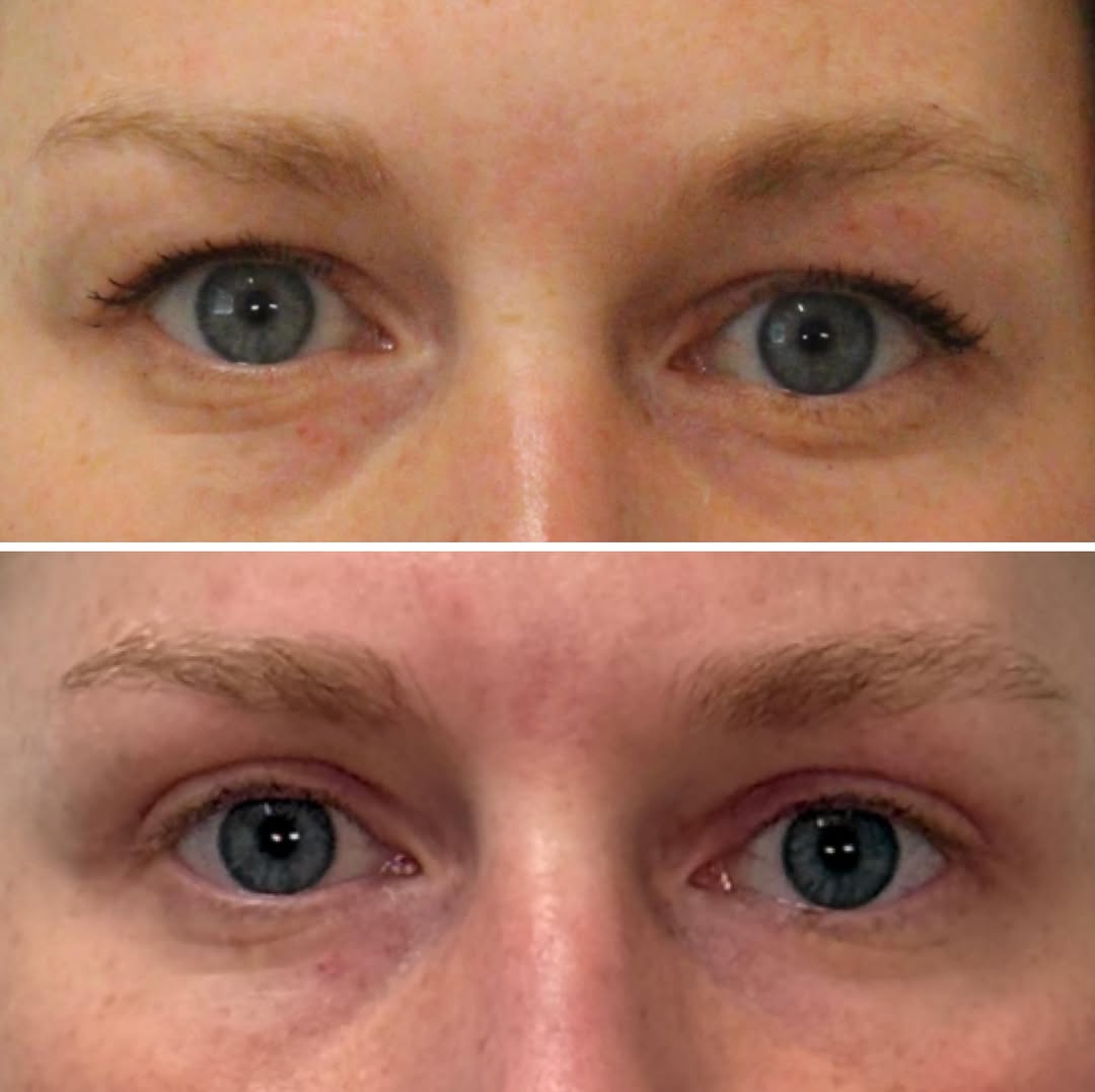 Instagram post by Dr. Emily M. Bratton: ✨Refresh for a lovely bride! ✨ 6 weeks after in-office cosmetic upper blepharoplasty looking bright (even without makeup) for her October we…