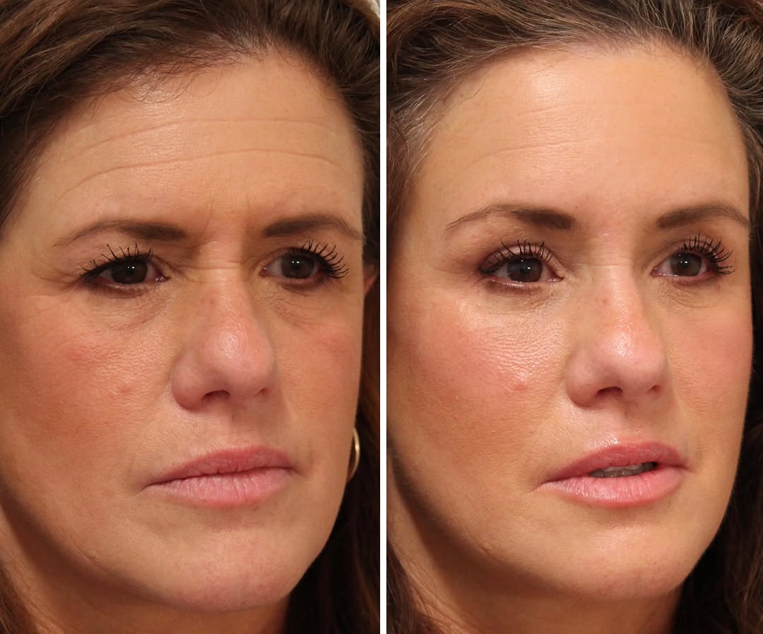 Instagram post by Dr. Emily M. Bratton: The softness of an endoscopic brow lift and periorbital fat grafting with upper blepharoplasty in my beautiful patient. There is no Botox he…