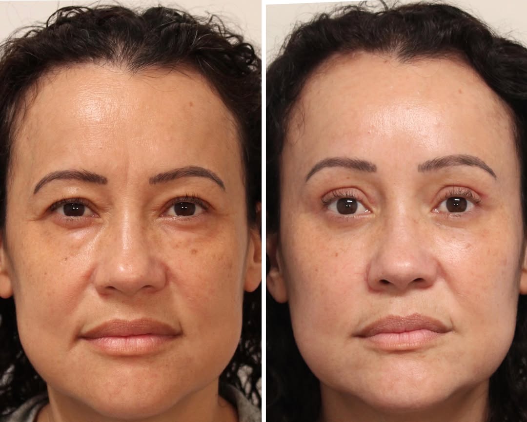 Instagram post by Dr. Emily M. Bratton: One month post op ✨Endoscopic Brow Lift, Upper Blepharoplasty, Lower Blepharoplasty, and Micro-Fat Grafting to under-eyes and cheeks✨ As my …