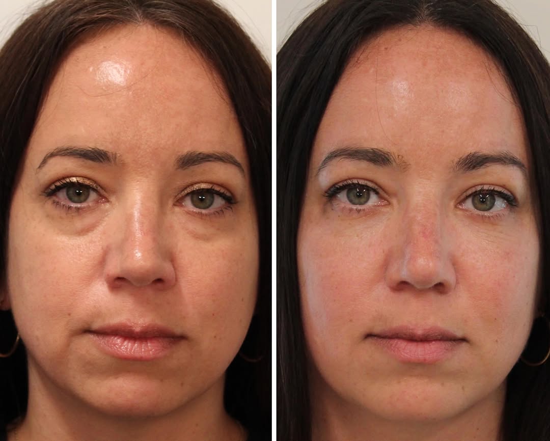 Instagram post by Dr. Emily M. Bratton: ✨Lower Blepharoplasty with Transposition and Periorbital Fat Grafting + TCA Chemical Peel ✨ One month post op with still some healing that w…