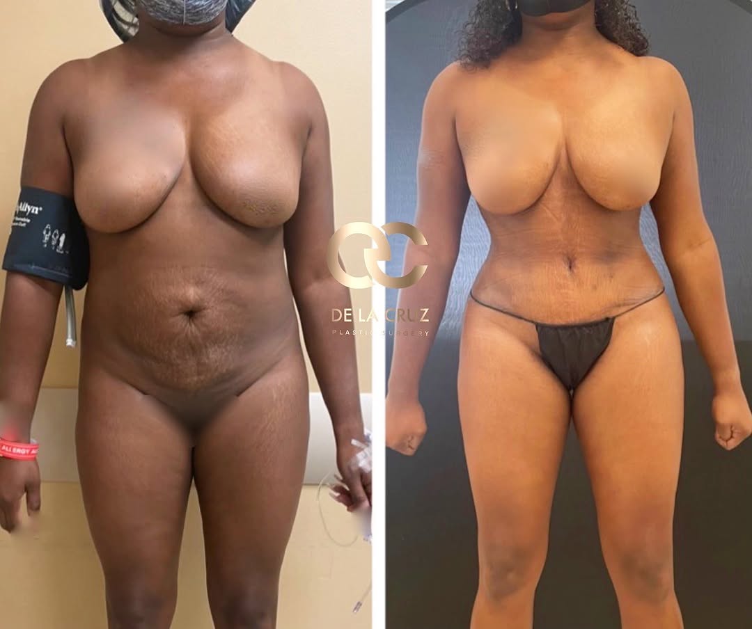 Instagram post by Dr. Emmanuel De La Cruz: This is a dramatic change I wanted to share with y’all 😱 Procedures: Hi-definition Abdominoplasty with VASER liposuction of the abdomen, ba…