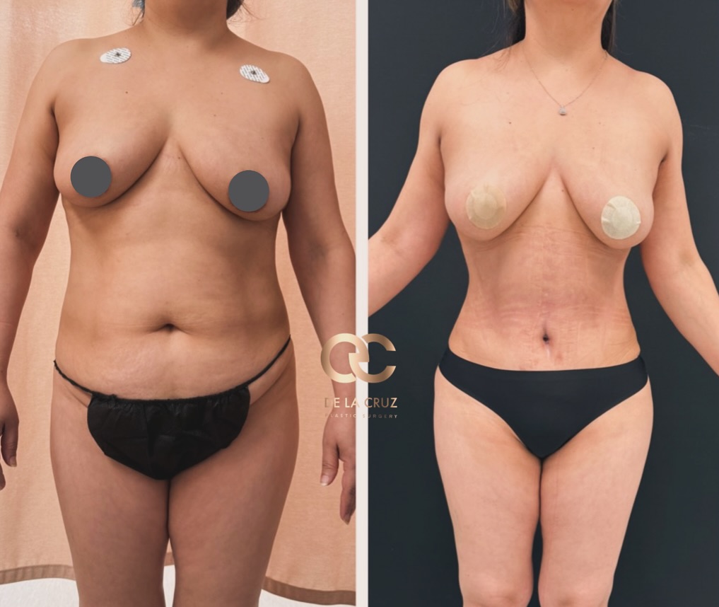 Instagram post by Dr. Emmanuel De La Cruz: ✨ 3 Months After Abdominoplasty ✨ Our beautiful patient is only 3 months post-op from her abdominoplasty (tummy tuck), and her transformatio…