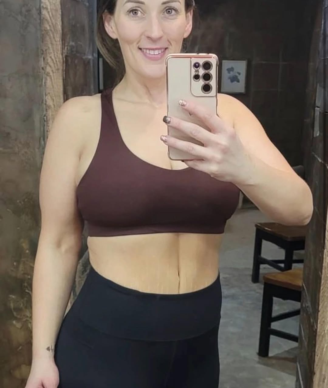 Instagram post by Dr. Eric Ashby: This patient is 9 months out from a Full Extended post weight loss Tummy tuck. We are so proud of her and happy to be a part of her journey …