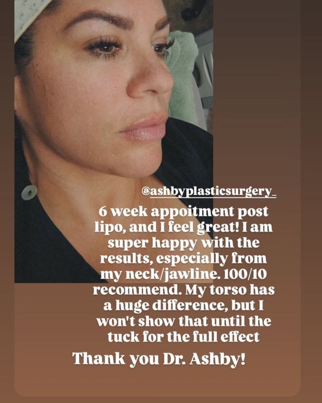 Instagram post by Dr. Eric Ashby: This neck is snatched. Dr. Ashby’s eye for detail is one of a kind. Liposuction and Sculpting the Neck, is a great way to achieve that beaut…