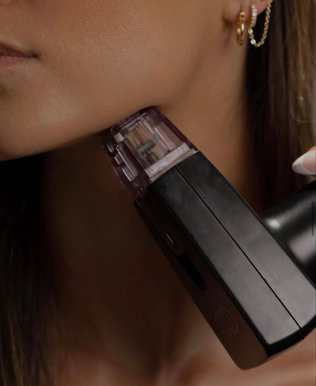 Instagram post by Dr. Eric Egozi: Get that sharp jawline and flawless skin you’re dreaming of with #Morpheus8 Call Dr. Egozi today at 727-461-5872 to inquire about Morpheus8.…