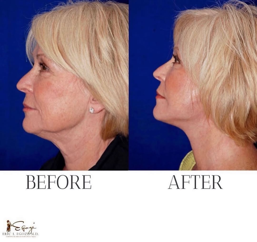 Instagram post by Dr. Eric Egozi: Dr. Egozi has an eye for detail and his expertise is unmatchable, just look at these results! This patient received a face lift and neck lif…