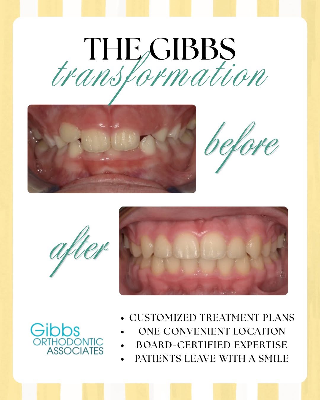 Instagram post by Dr. Eric Gibbs, DDS: Proof that small changes over time can make a big difference. 😁✨ The journey is different for every patient, but the goal is always the sam…