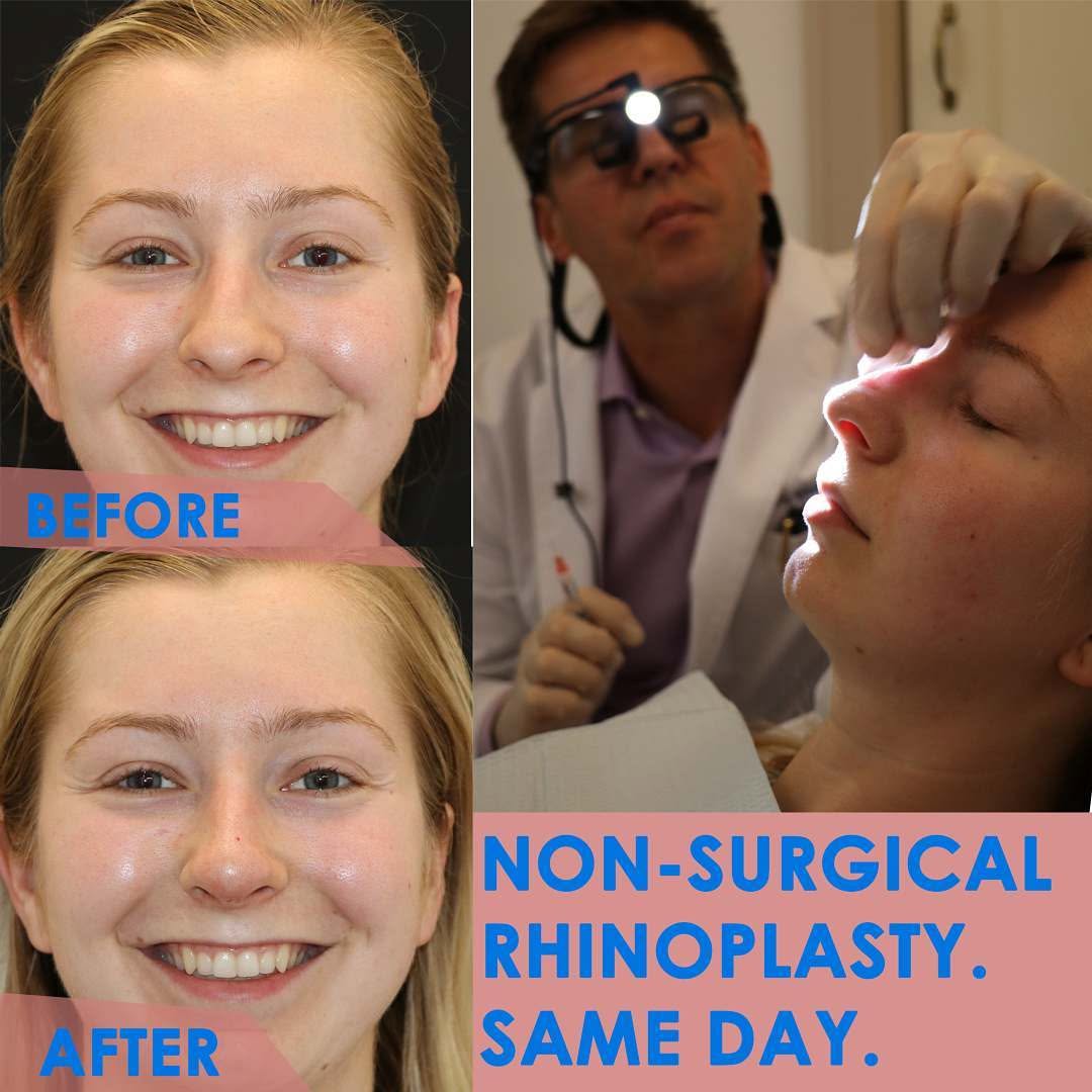 Instagram post by Dr. Eric T. Waterman: Non-surgical Rhinoplasty is a great option for people who want a new look without the wait. Fillers can achieve all sorts of minor correctio…