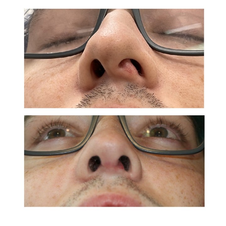 Instagram post by Dr. Eric T. Waterman: Cosmetic Rhinoplasty is often about dorsal humps and droopy tips- but don't forget about the base view! A crooked nose on this view tells me…