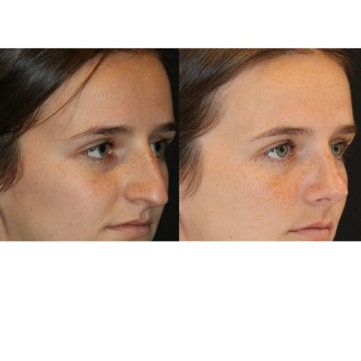 Instagram post by Dr. Eric T. Waterman: Reducing a dorsal hump is one of the most common reasons for wanting a rhinoplasty and there are a variety of ways of doing it. The newest t…