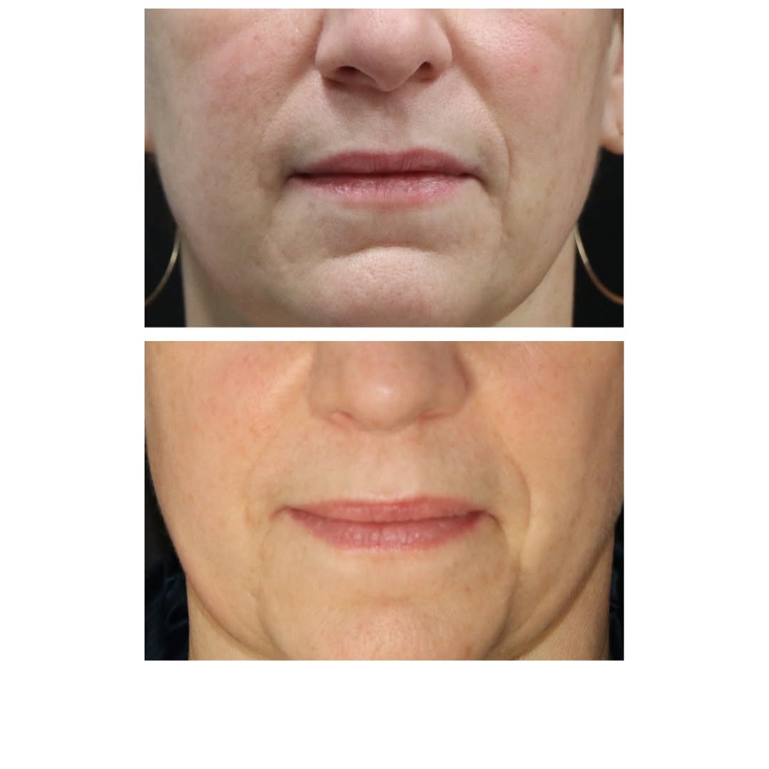 Instagram post by Dr. Eric T. Waterman: Asymmetry at the base of the nose is one of the hardest things to correct in Rhinoplasty. This patient had asymmetric nostrils and asymmetry…