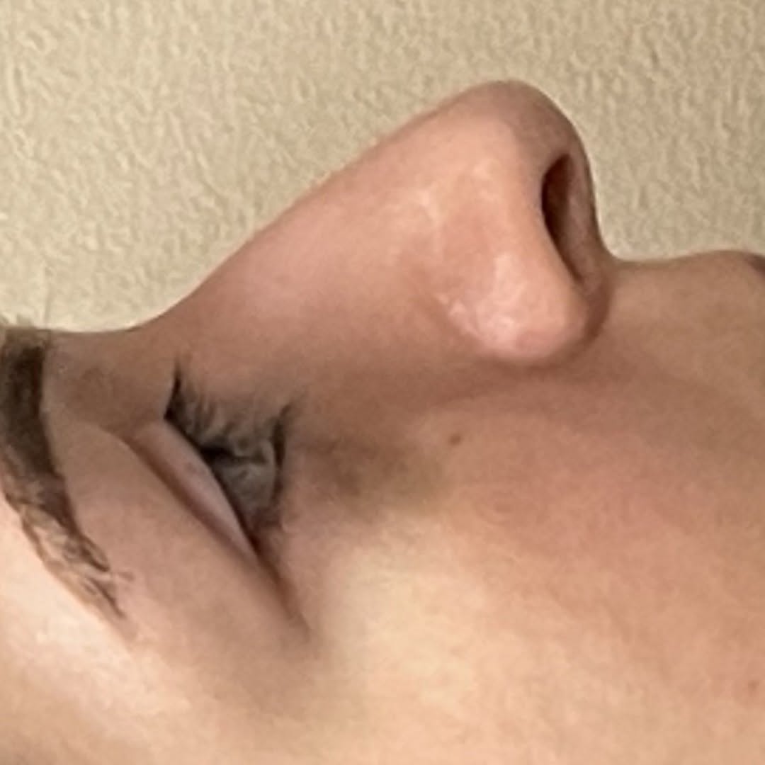 Instagram post by Dr. Eric T. Waterman: Immediate post-op result after cosmetic rhinoplasty. This is a lovely young women who was bothered by her dorsal hump and wanted a more femi…