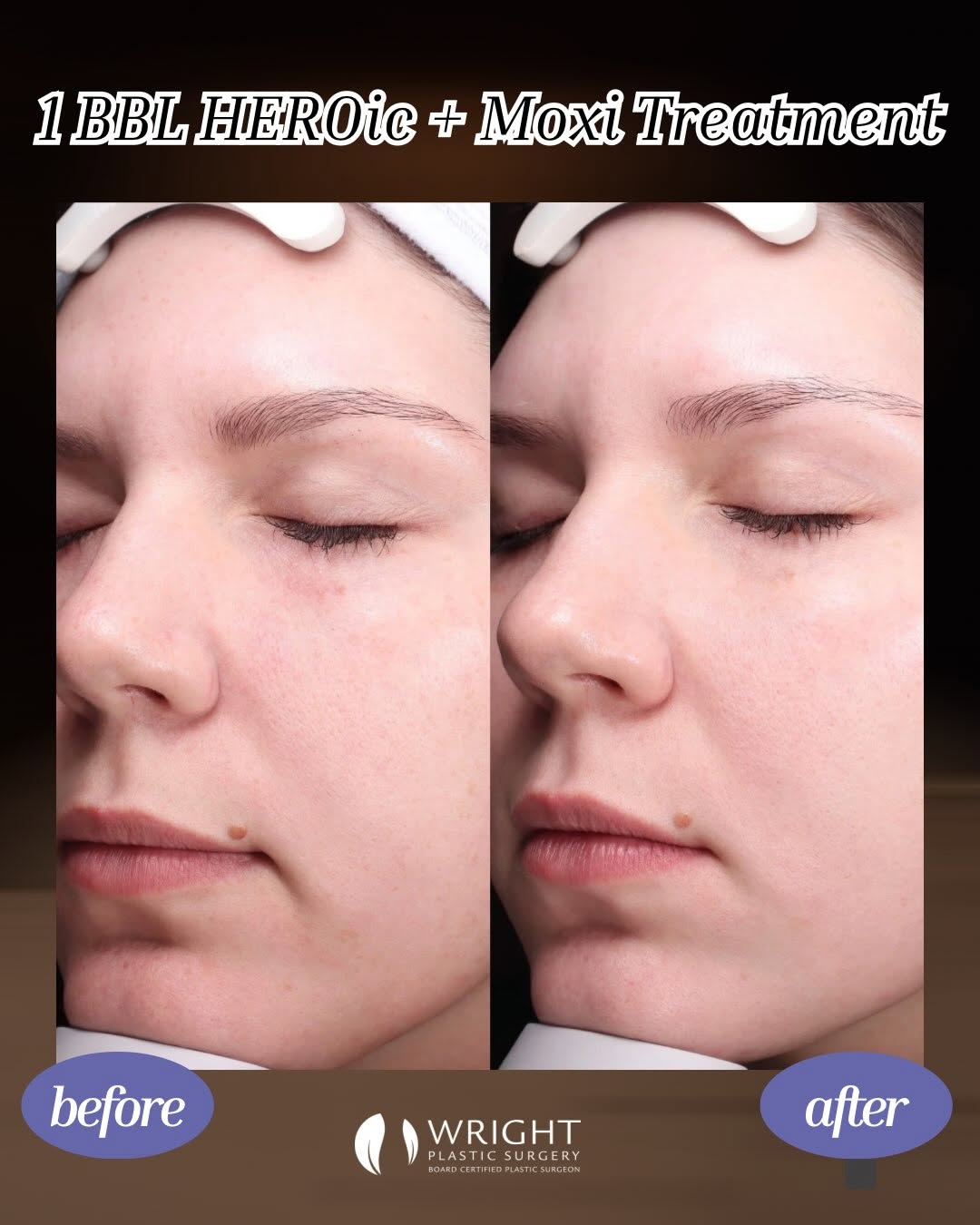 Instagram post by Dr. Eric Wright: 💫Transformation Tuesday With our Lasers & Lattes event coming up on Thursday, we would love to highlight a laser transformation. We are con…