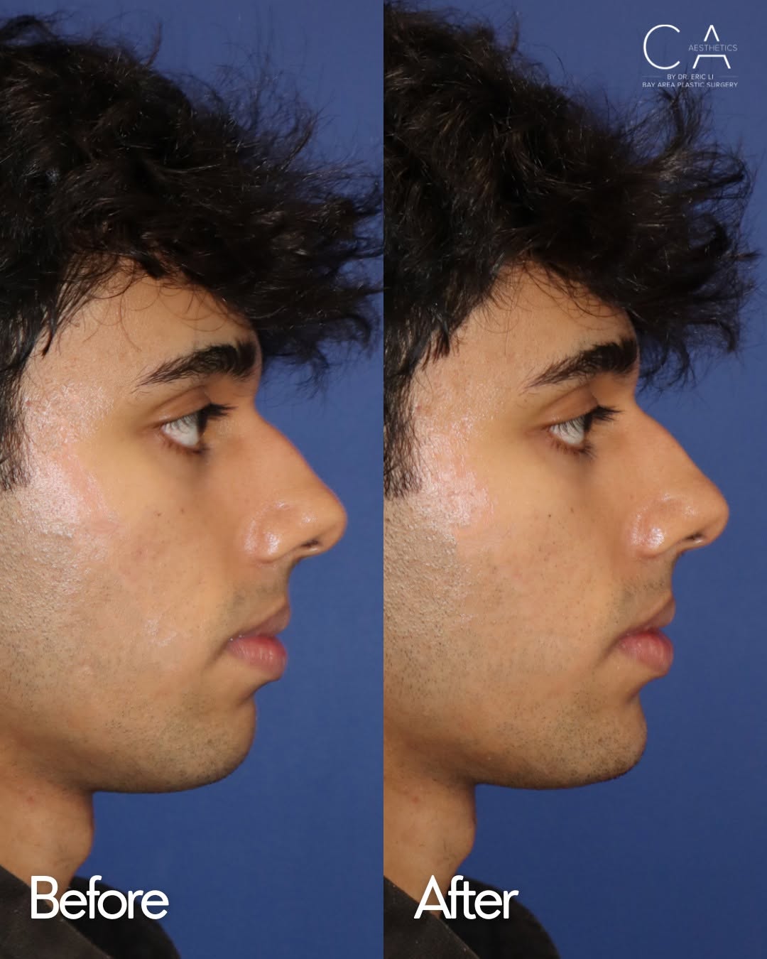 Instagram post by Dr. Eric YK Li: A well-defined chin can add structure and balance to the entire face ✨ We call this facial balancing! For men, building projection and width…