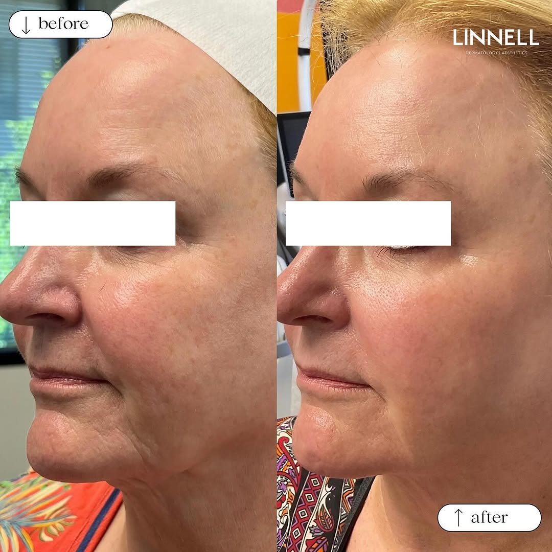 Instagram post by Dr. Erica Linnell: This is why ULTRACLEAR is one of our favorite lasers ⬇️ Check out this patient’s incredible results after just 1 SESSION of the ultraclear l…