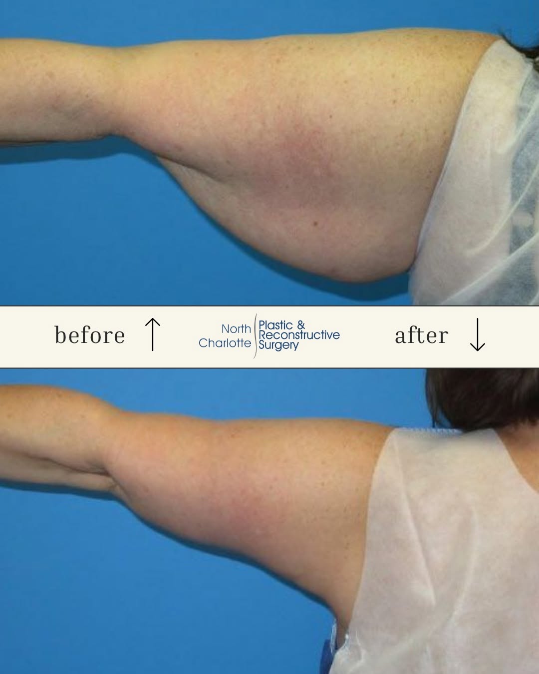 Instagram post by Dr. Erik Miles: A brachioplasty, also known as an arm lift, is designed to address loose, hanging skin along the upper arms. For appropriate candidates, the…