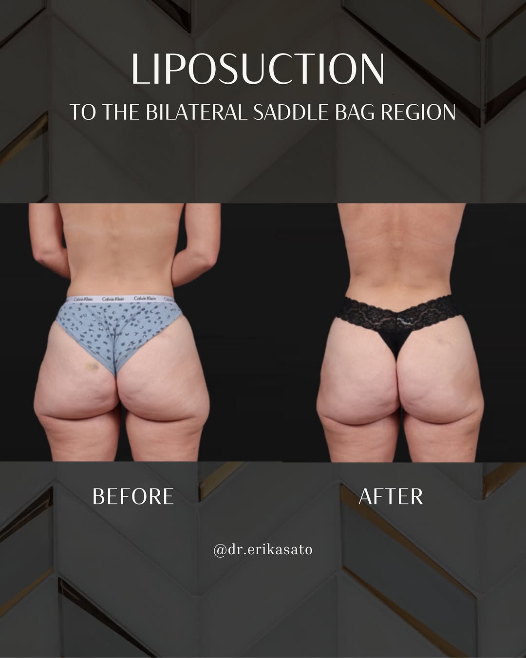 Instagram post by Dr. Erika Sato: Sometimes, it’s the most targeted changes that make the difference. This patient had a very specific area she wanted to address: the outer t…