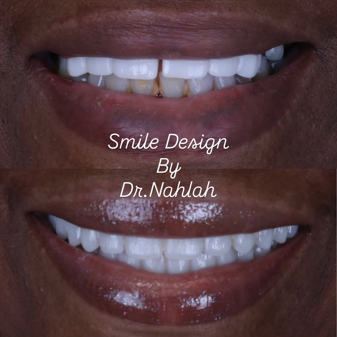 Instagram post by Dr. Esam Abou Nahlah, DDS, MS, FICOI: A smile transformation is about more than brighter, straighter teeth—it’s about creating harmony, proportion, and a smile that belongs natur…