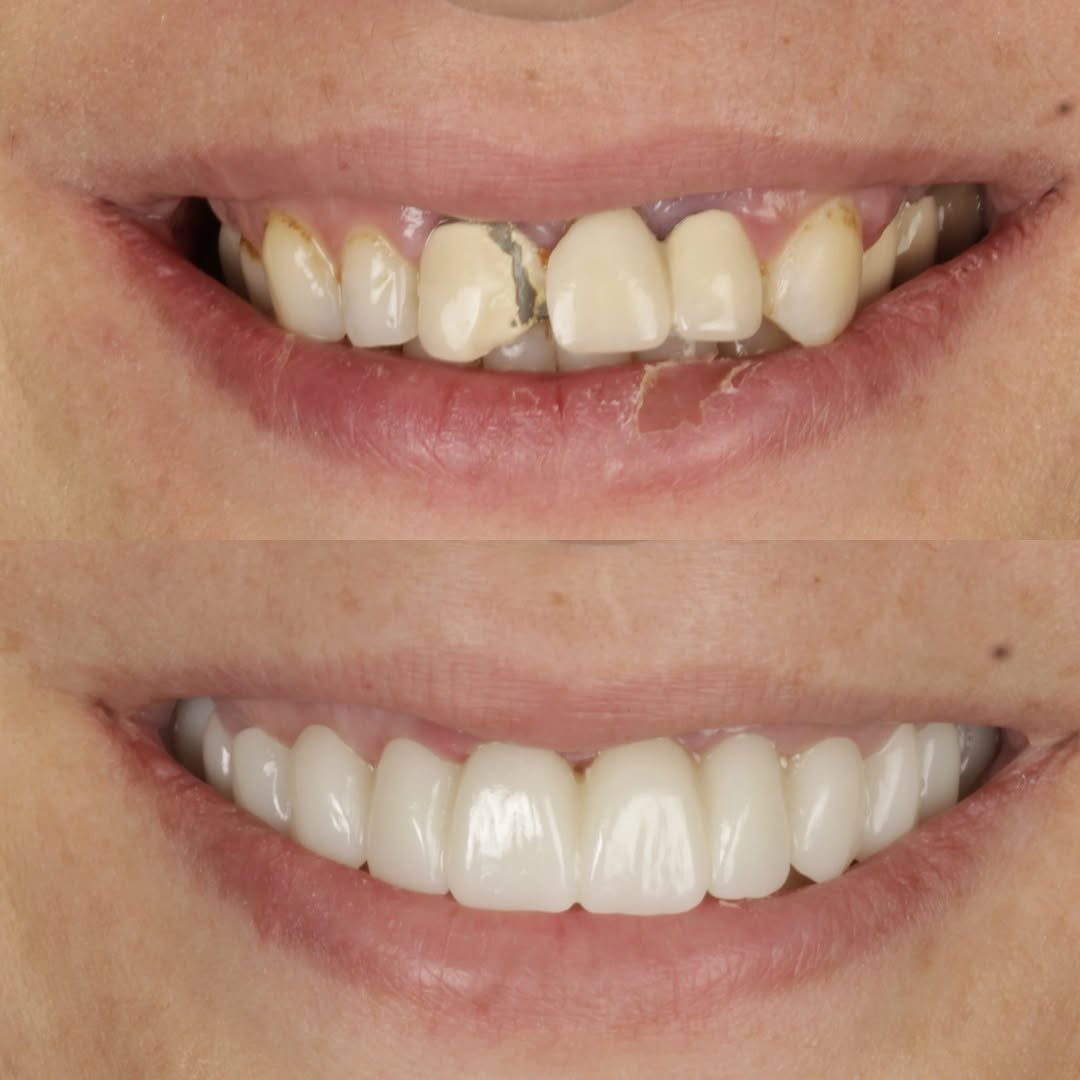 Instagram post by Dr. Esam Abou Nahlah, DDS, MS, FICOI: From broken and compromised… to a smile that feels whole again. ✨ This transformation is about more than replacing teeth—it’s about restorin…