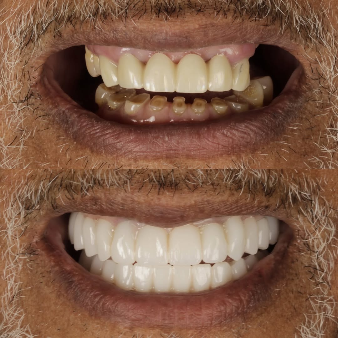 Instagram post by Dr. Esam Abou Nahlah, DDS, MS, FICOI: From broken teeth to a brand-new smile. 🔥🦷 Years of wear. A compromised bite. A smile ready for a second chance. This is the power of adva…