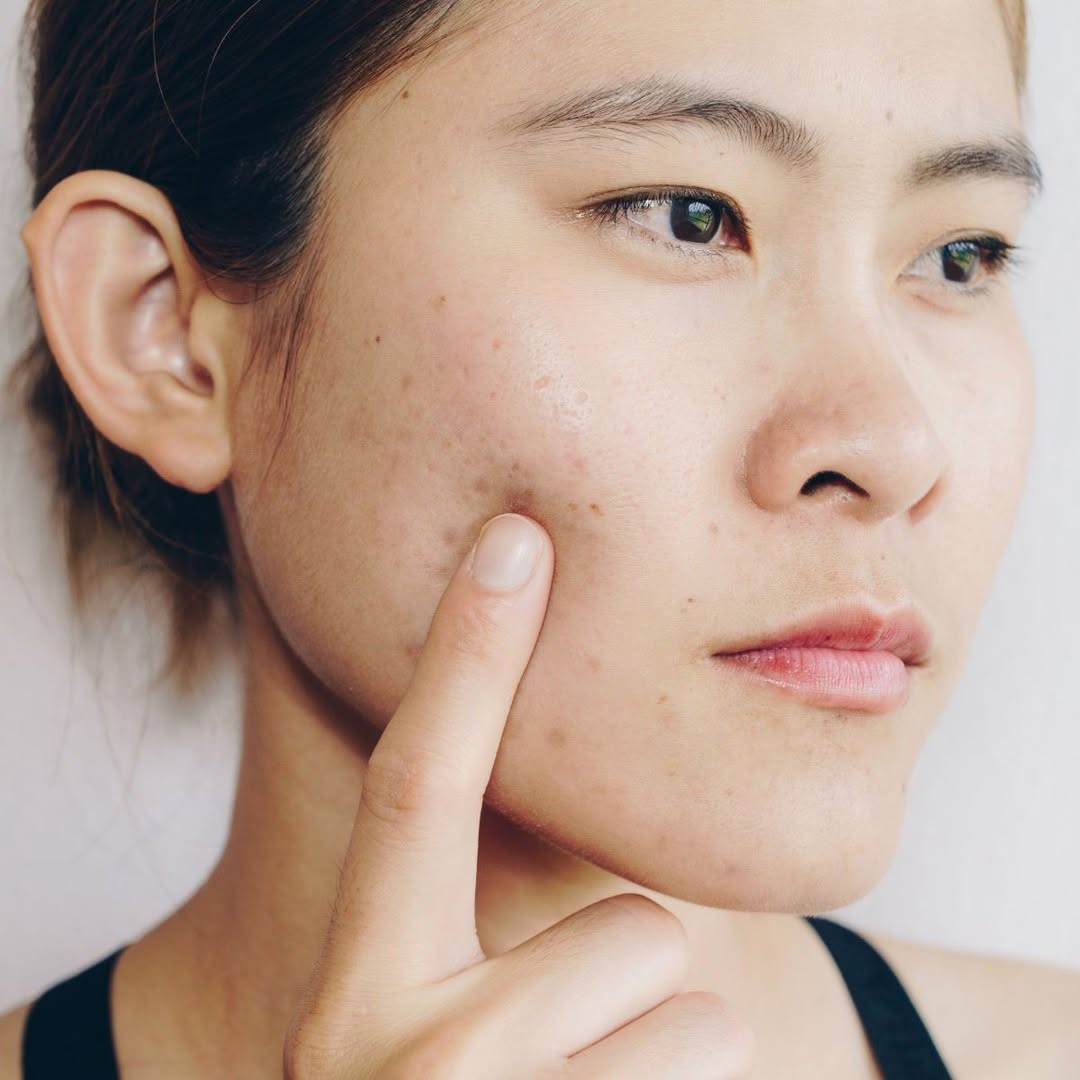 Instagram post by Dr. Esta Kronberg: Acne scars can take a toll on your self-esteem. Luckily, we offer treatment options to help improve their appearance! Give us a call today t…