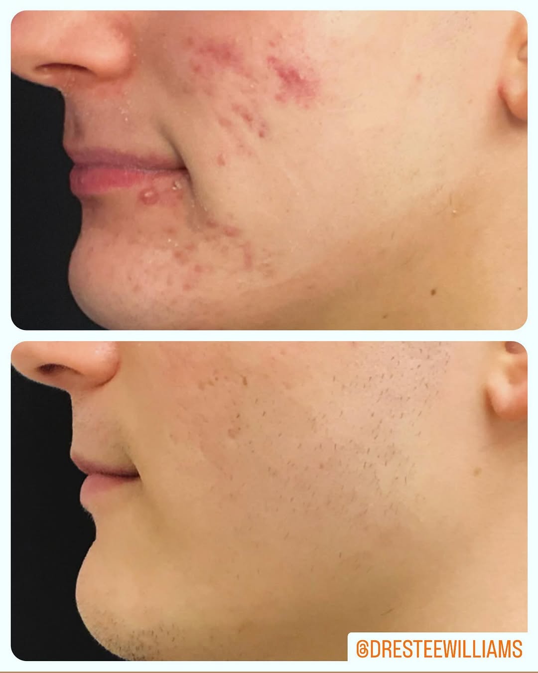 Instagram post by Dr. Estee Williams: Excellent acne recovery and scar transformation case. Grateful for the patience of acne patients. This patient came to me in the middle of h…
