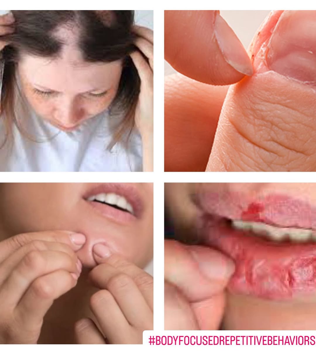 Instagram post by Dr. Estee Williams: Dermatillomania (i.e. skin picking) and hair pulling (trichotillomania) disorders—also known as body-focused repetitive behaviors, or BFRBs—…