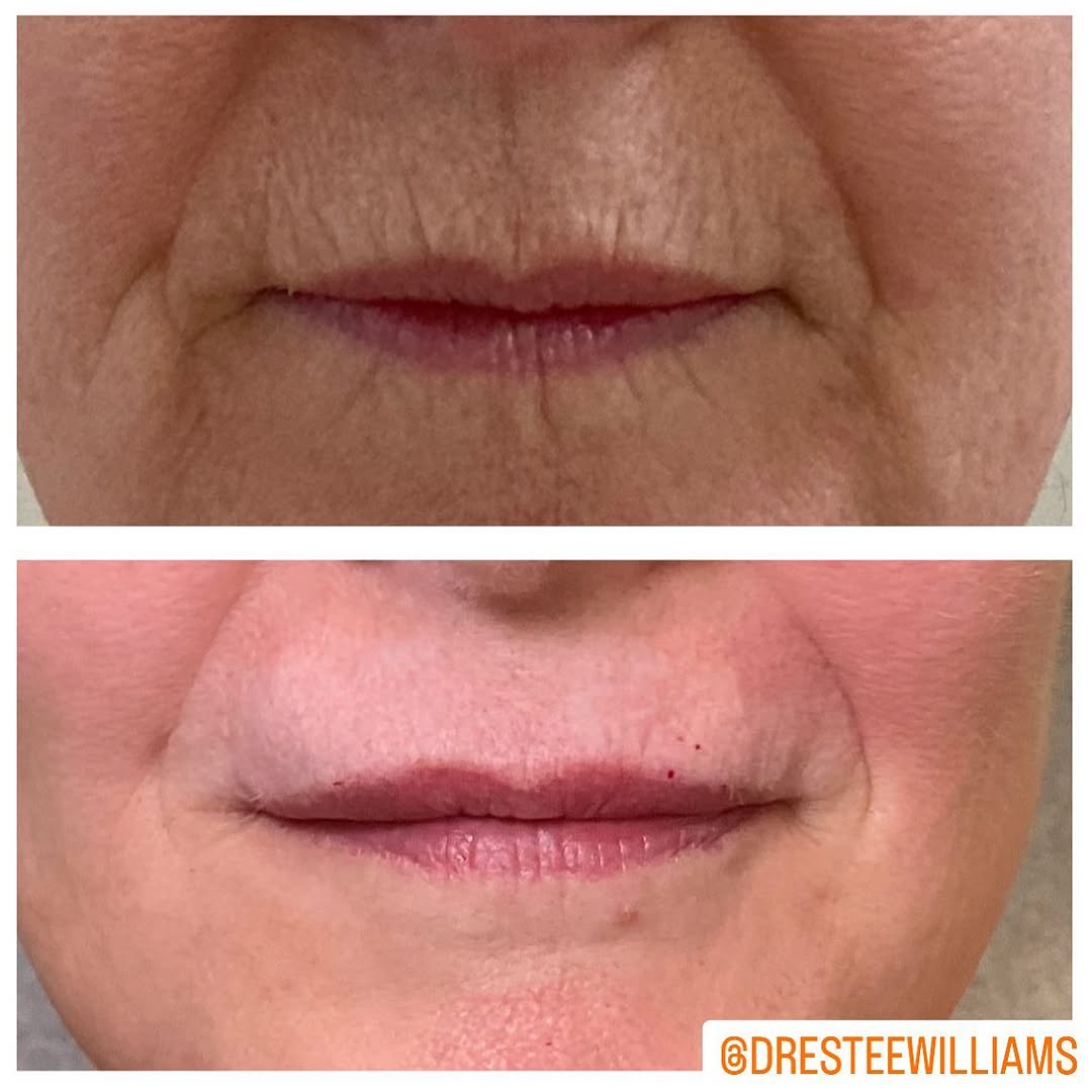 Instagram post by Dr. Estee Williams: These unedited photos show the improvement of deep, etched-in lines around the mouth and enhanced definition of the lip border. I used CO2 l…