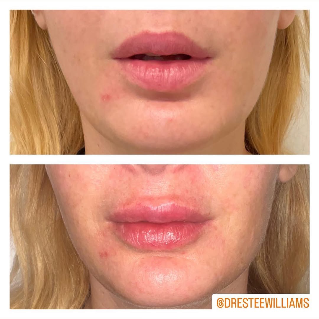 Instagram post by Dr. Estee Williams: Sometimes we use 💉filler to harmonize facial features, and not to target a wrinkle or plump or contour. No one is perfectly even, but some …