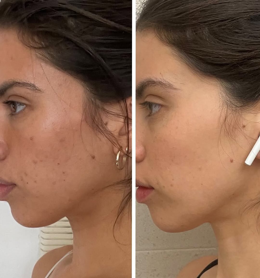 Instagram post by Dr. Estee Williams: Take a look at my patient’s acne transformation🌟. While adult acne is usually not as widespread on the face as teenage acne, the pimples ca…