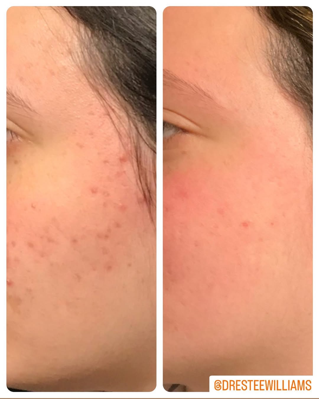 Instagram post by Dr. Estee Williams: It’s gratifying to see a teenage patient’s skin clear up over time. With acne, it’s important to never give up. Fortunately, we have many op…