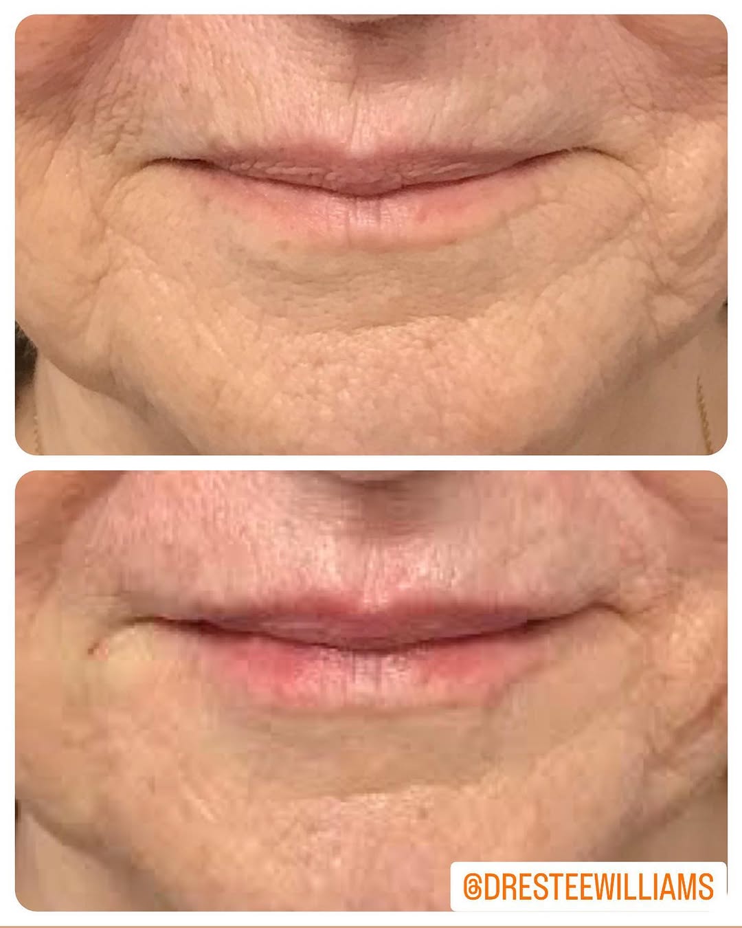 Instagram post by Dr. Estee Williams: Lip filler gets a bad rap because of people who think that looking like you’ve had an anaphylactic reaction on your face is attractive. Bigg…