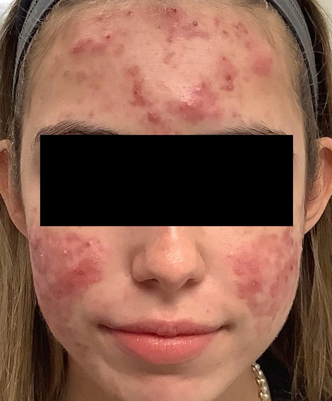 Instagram post by Dr. Estee Williams: This was a challenging acne case that I was called on for a second opinion. The patient was started on Accutane with another provider, and e…