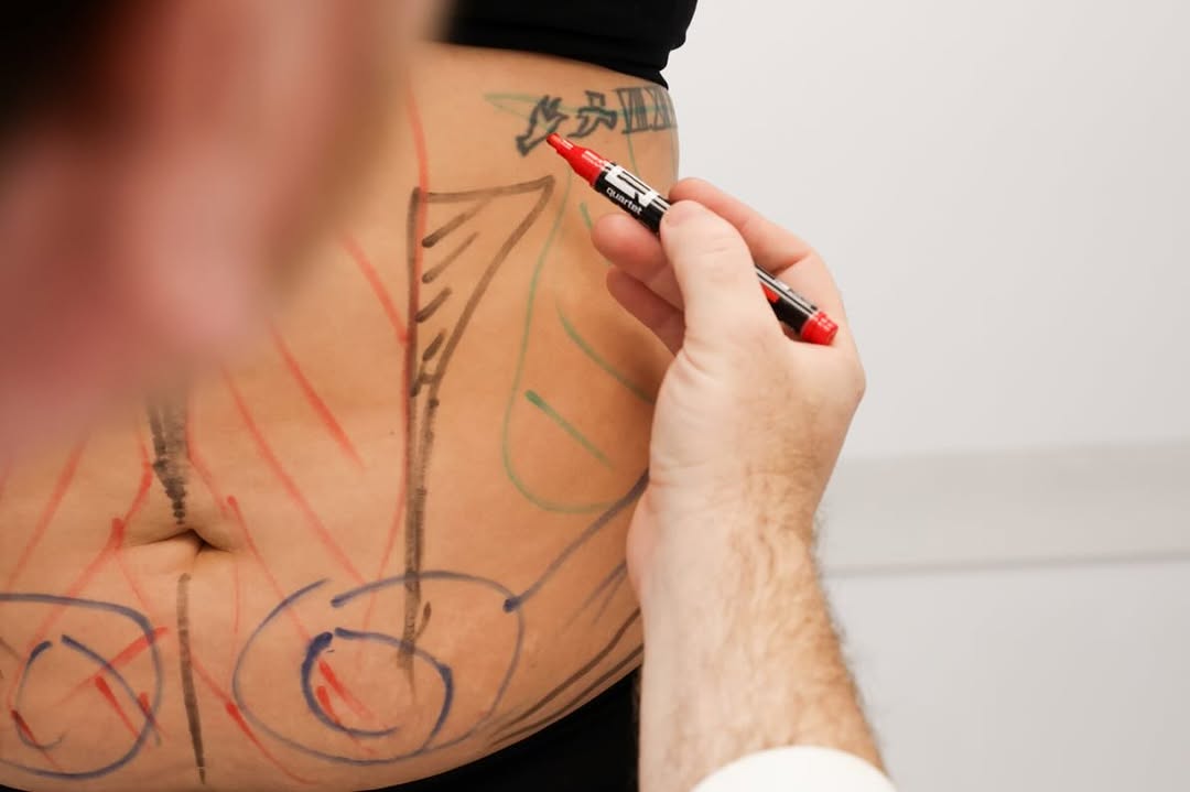 Instagram post by Dr. Ethan E. Larson: “A tummy tuck is more than just removing excess skin—it’s about restoring confidence. Whether due to pregnancy, weight loss, or aging, loose…