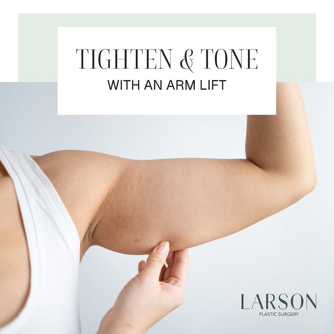Instagram post by Dr. Ethan E. Larson: “If loose skin on your arms is keeping you from feeling confident, an arm lift can restore a firmer, more sculpted look. This procedure remo…