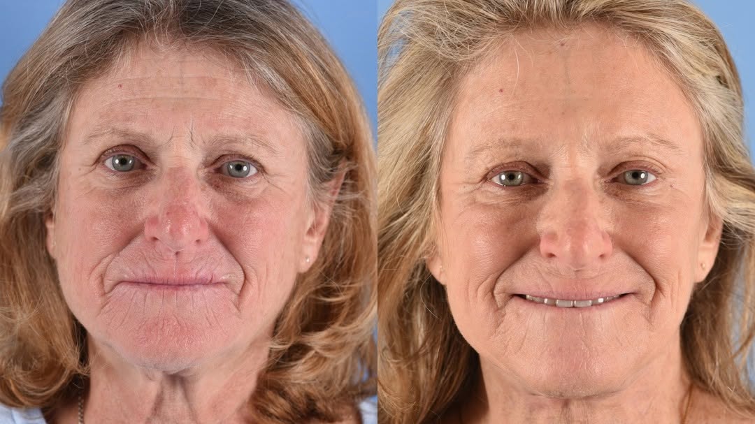 Instagram post by Dr. Eugene L. Alford: When you help your patient achieve, “feeling like my age matches how I feel”. #EndoscopicBrowlift #DeepplanSMASectomyfacelift #Platysmaplast…