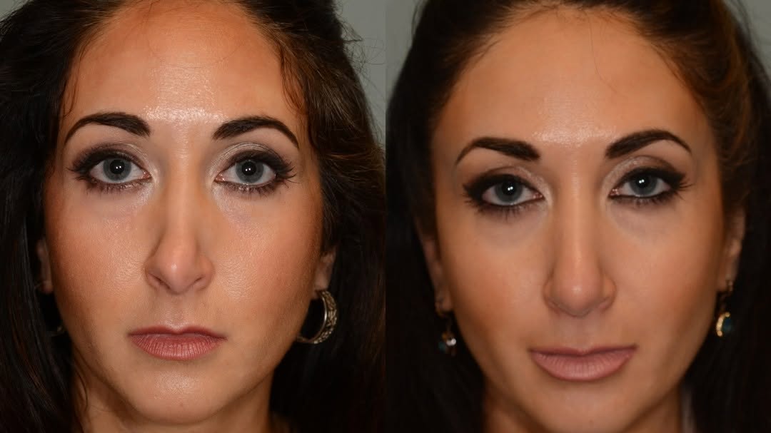 Instagram post by Dr. Eugene L. Alford: When your first rhinoplasty left you with a malformed nose, you seek another to help change that! #houstonplasticsurgeon #houstonplasticsurg…