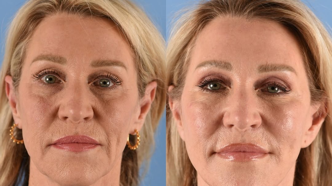 Instagram post by Dr. Eugene L. Alford: This lovely and beautiful woman came to see me because she did not “feel” her age. After specialized techniques for a face and neck lift, sh…