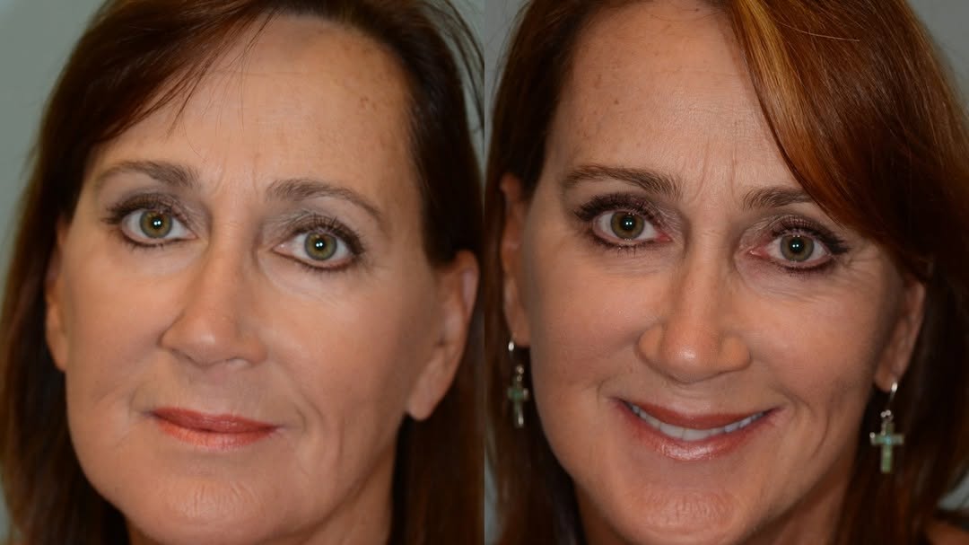 Instagram post by Dr. Eugene L. Alford: With specialized techniques tapered for each individual, this patient was able to reach her goal and reverse the clock on the areas that bot…