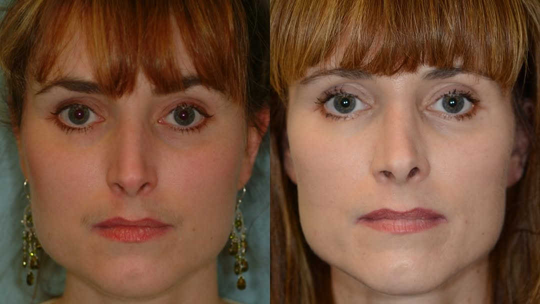 Instagram post by Dr. Eugene L. Alford: Great results for someone needing to breathe easy and feel better! Get your consultation today! #houstonplasticsurgeon #houstonplasticsurger…