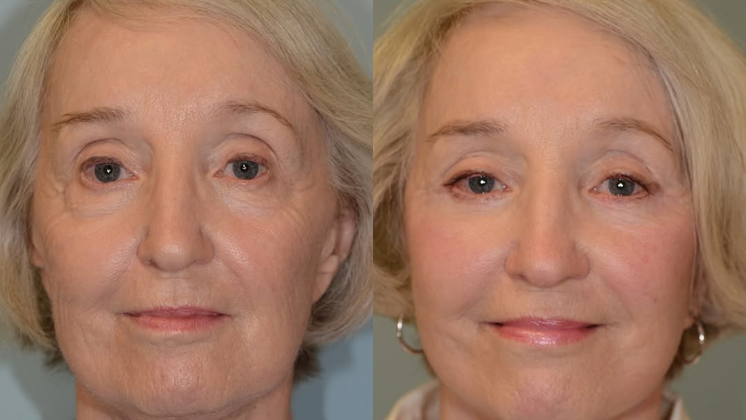 Instagram post by Dr. Eugene L. Alford: This lovely and beautiful woman came to see me because she did not “feel” her age. After specialized techniques for a face and neck lift, sh…