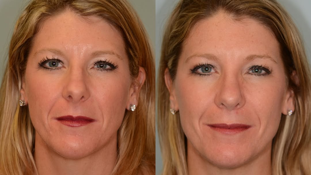 Instagram post by Dr. Eugene L. Alford: Great results for someone needing to breathe easy and feel better! Get your consultation today! #houstonplasticsurgeon #houstonplasticsurger…