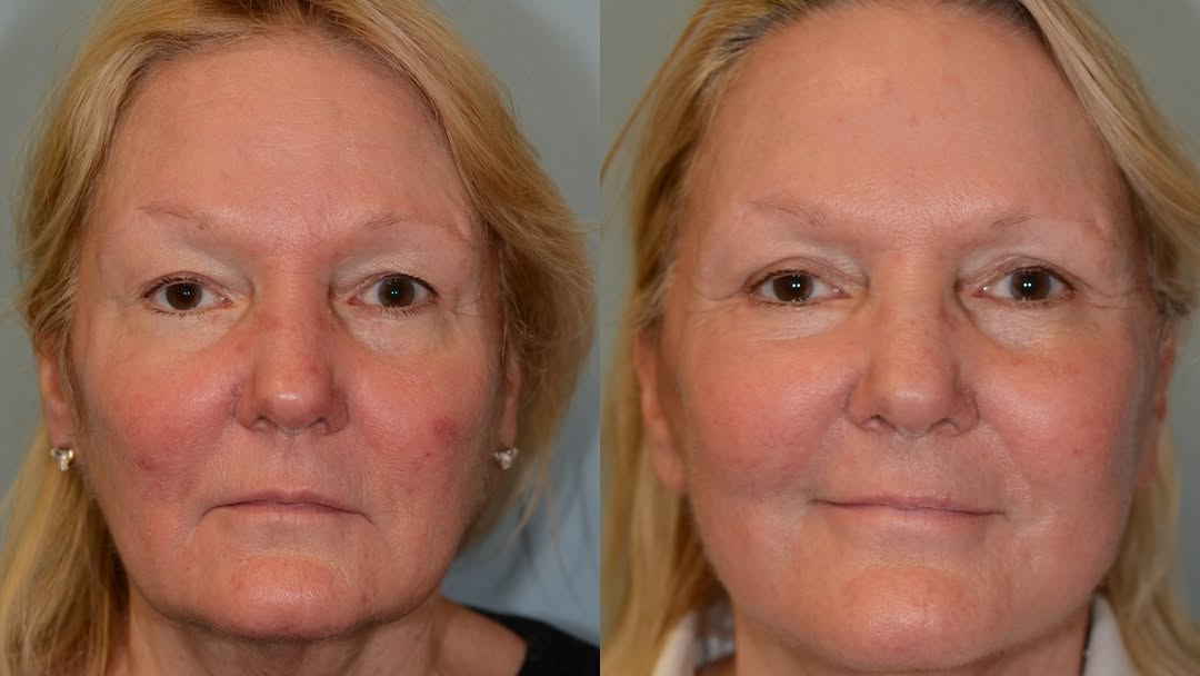 Instagram post by Dr. Eugene L. Alford: With specialized techniques tapered for each individual, this patient was able to reach her goal and reverse the clock on the areas that bot…
