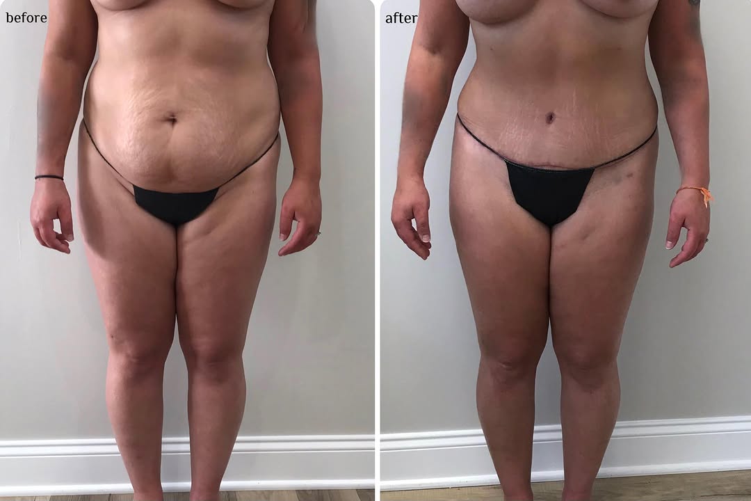 Instagram post by Dr. Evan Manolis: The power of a Tummy Tuck + Liposuction combo 👏 Call in today to book your free consultation with Dr. Evan Manolis 708-873-9600