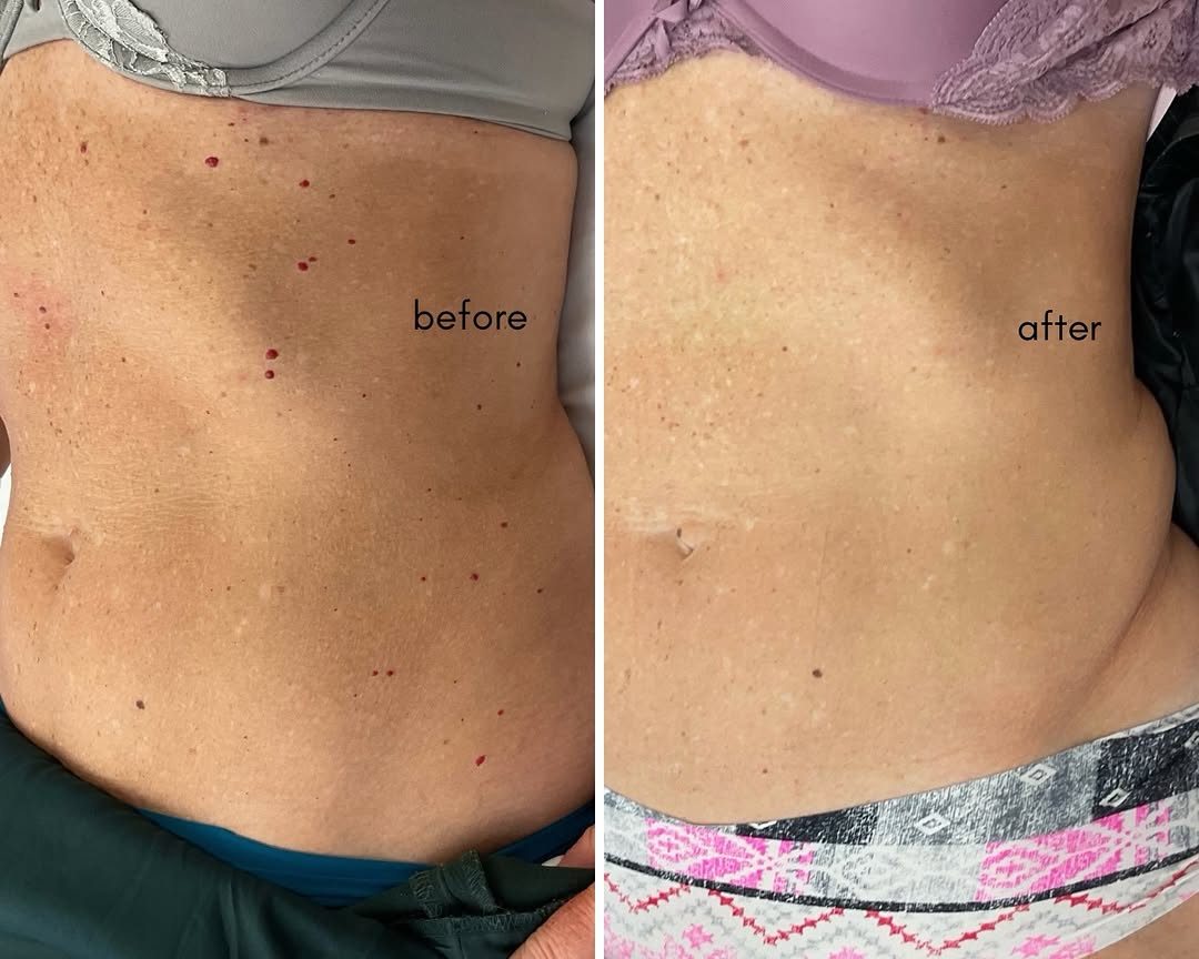 Instagram post by Dr. Evan Manolis: If you’ve ever wondered whether those little red spots can be removed, the answer is yes. ✨ Cherry angiomas can be treated in office with mi…