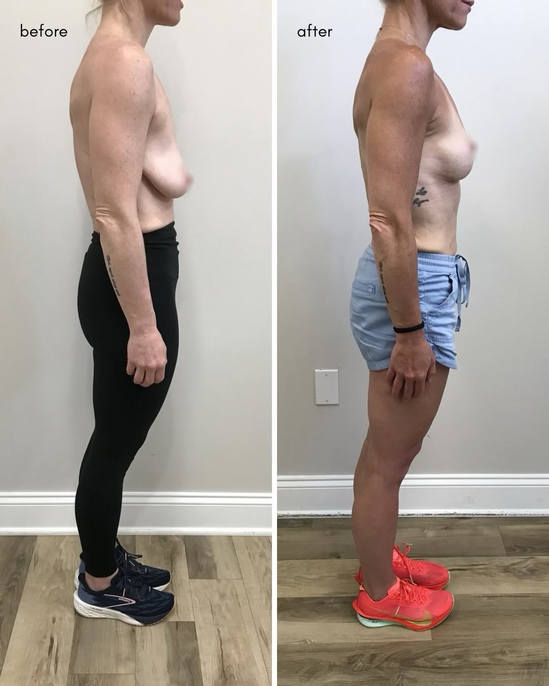 Instagram post by Dr. Evan Manolis: Breast lift by Dr. Manolis 😍 Call 708-873-9600 to book your complimentary consultation!