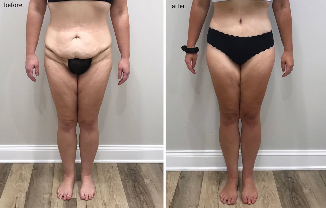 Instagram post by Dr. Evan Manolis: Tummy tuck + Liposuction A smoother, more defined contour and a beautiful transformation Thinking about a tummy tuck? Call our office to sch…